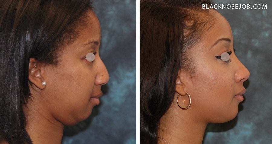 Figure a,b: African American rhinoplasty patient profile view with significant improvement in harmony between the nose and chin and overall facial profile.