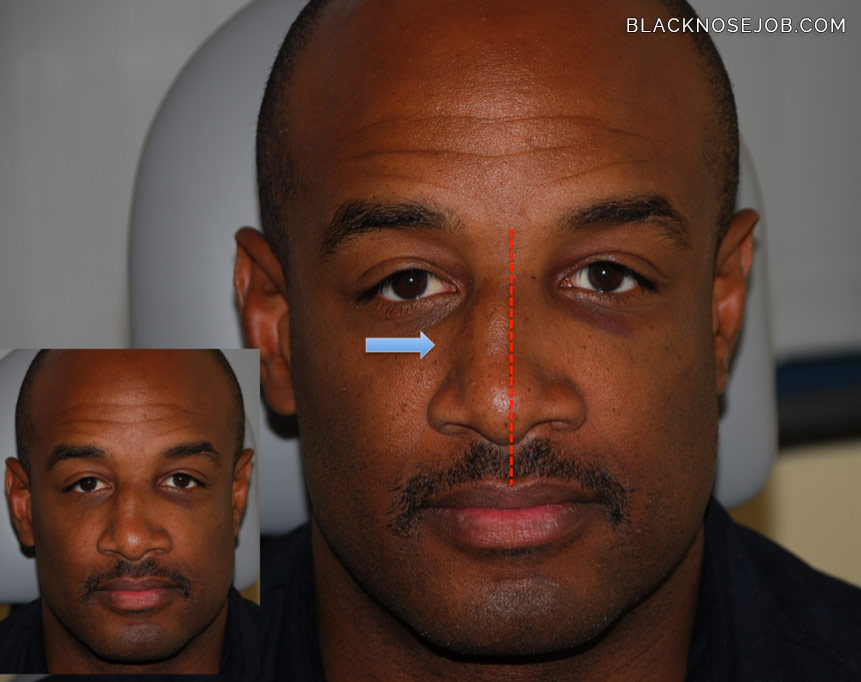 black male rhinoplasty