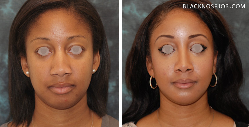 Before u0026amp; After Nose Job 2 | Orange County Facial Surgeon